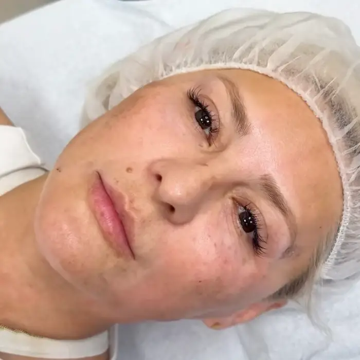 Patient prepared for an Endolift facial treatment
