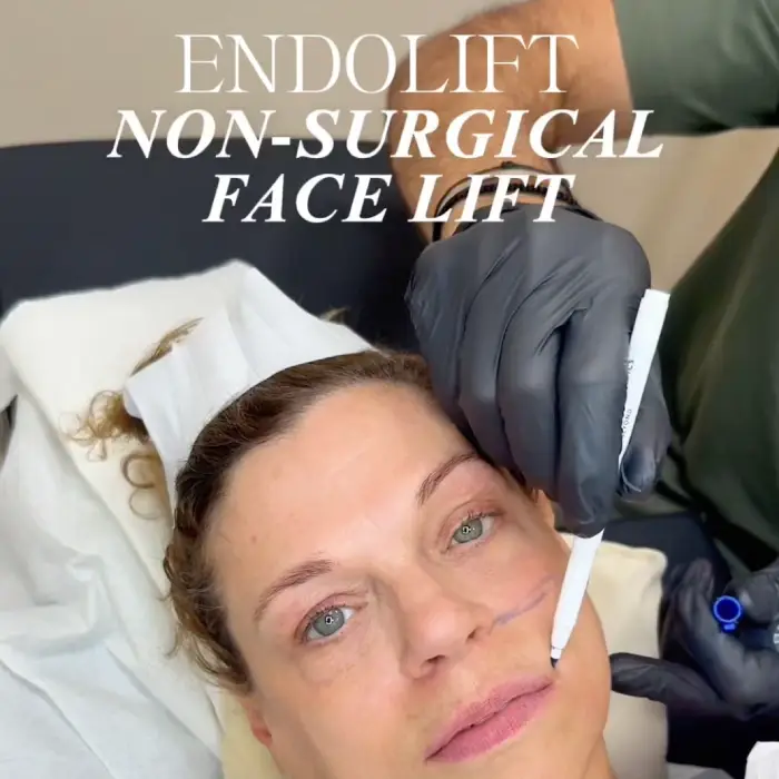 Endolift treatment being performed on a patient's lower face
