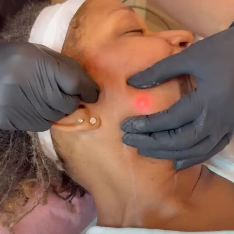 Endolift laser treatment along the jawline and neck area